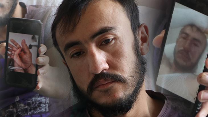 Üzerine yıldırım düştü, bu hale geldi: Bacaklarımın patladığı gözümün önüne geliyor