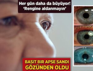 Kolay bir apse sandı, gözünden oldu! Her gün daha da büyüyor: ‘Rengine aldanmayın’